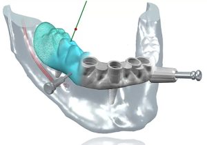Cirugía dental guiada en Sevilla